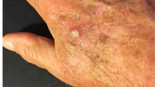 actinic keratosis