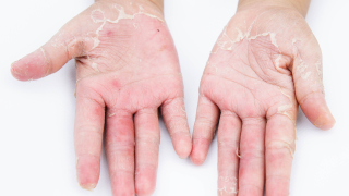 Occ contact dermatitis 1