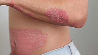 psoriasis 2