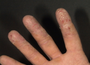 Module 2: Contact Dermatitis Overview